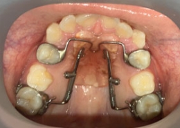 Orthodontic Appliances Blog Post