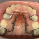Orthodontic Appliances Blog Post